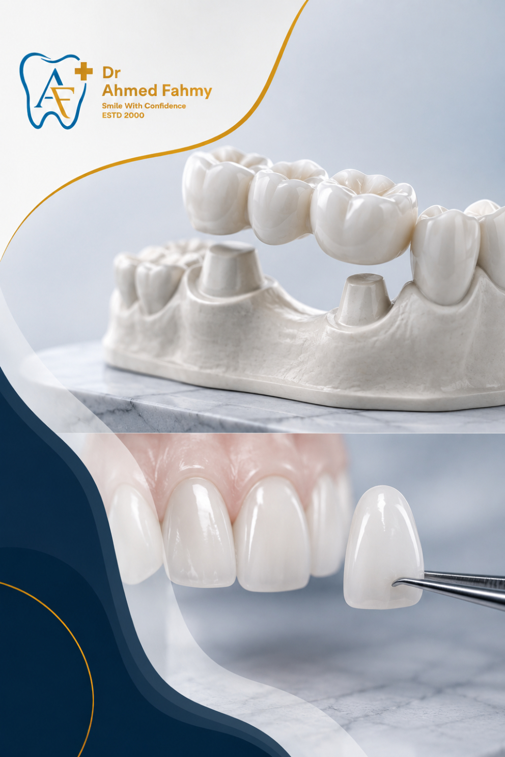 Fixed Prosthodontics & Dental Veneers